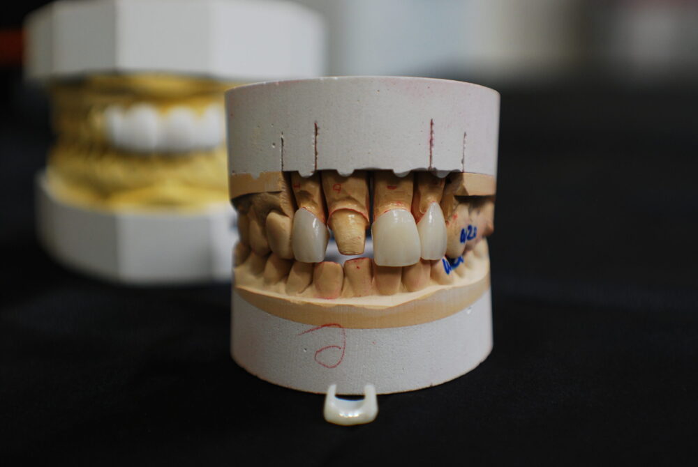 dental veneers