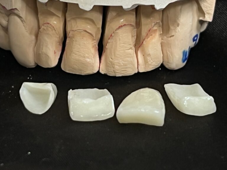 emax veneers