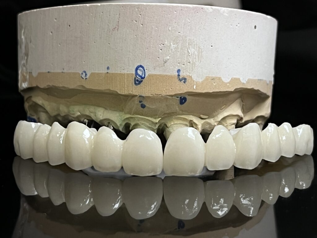 full mouth implant