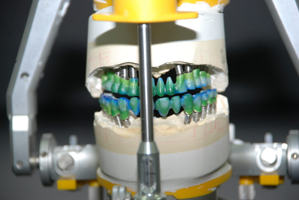 implant restoration