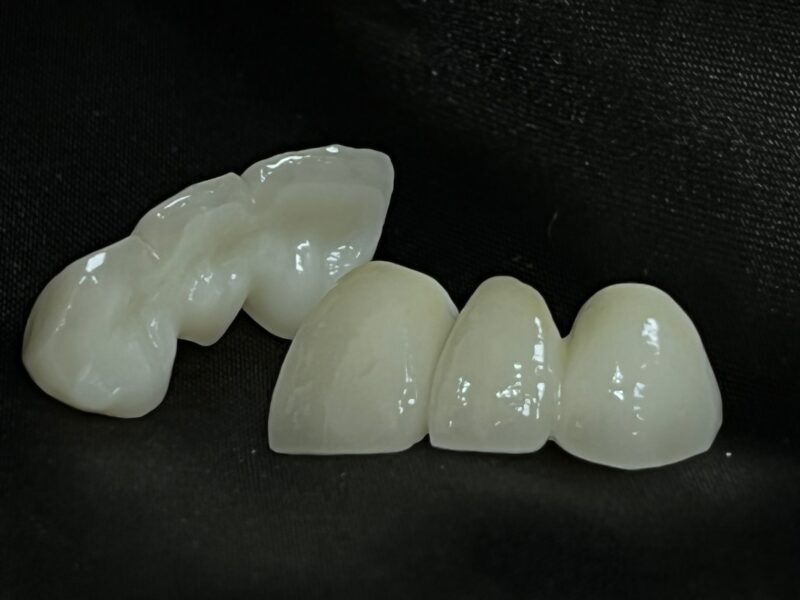 layered zirconia bridegs