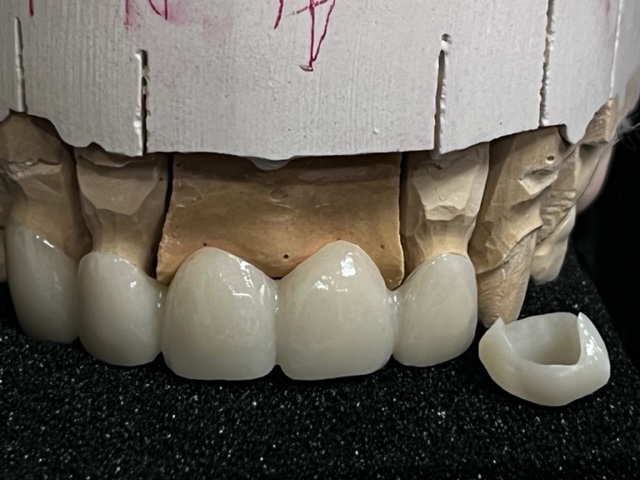 layered zirconia + emax veneers