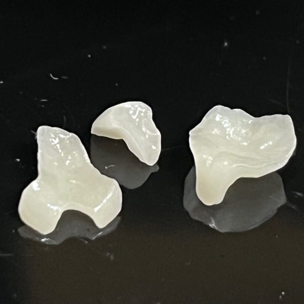 dental inlay