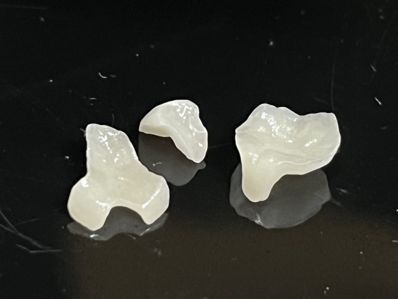 dental inlay