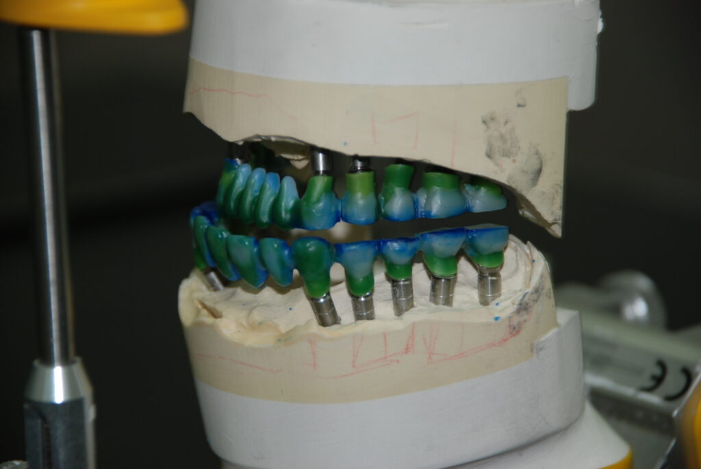 implant restoration