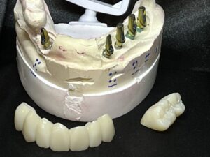 implant bridges