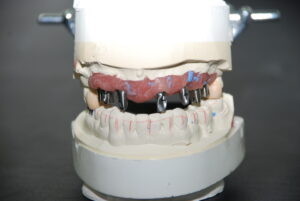 implant restoration-1