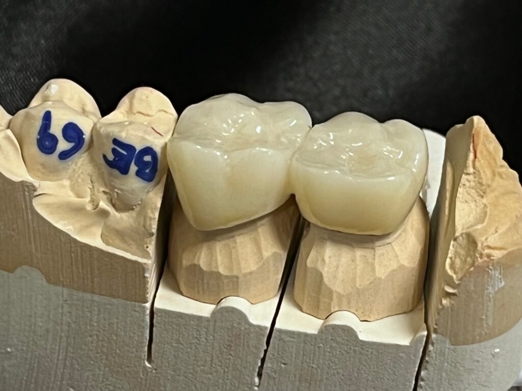 full zirconia bridge