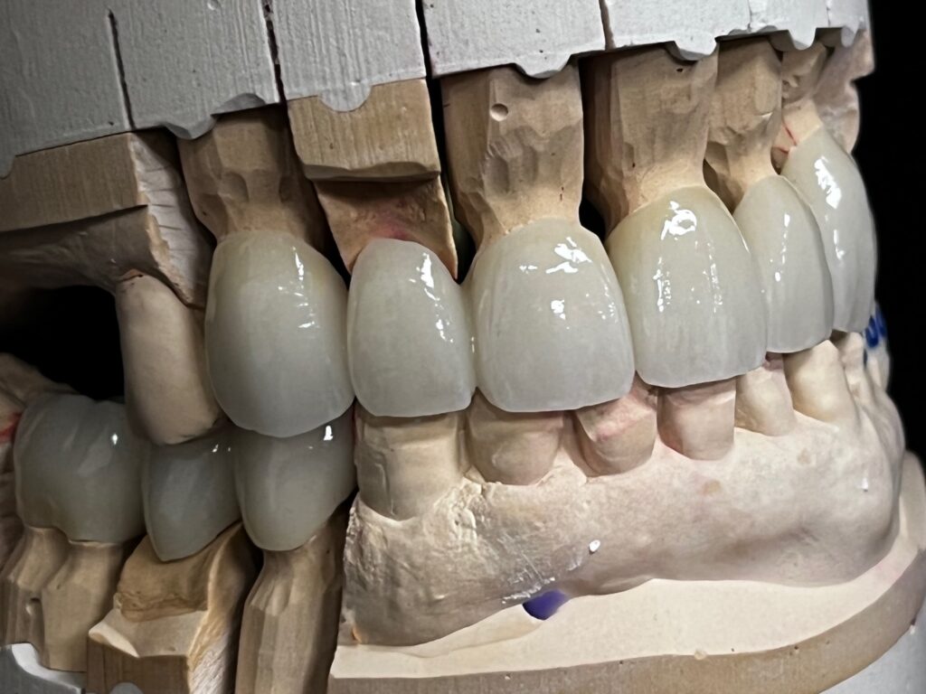 layerd zirconia crowns & bridges