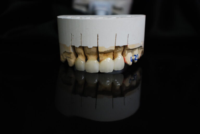 layered Zirconia anterior crown