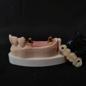 digital implant with custom abutment