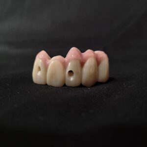 implant bridge with pink porcelain