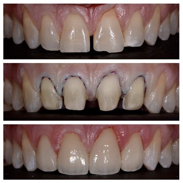 patient crown delivery dr chae (1)