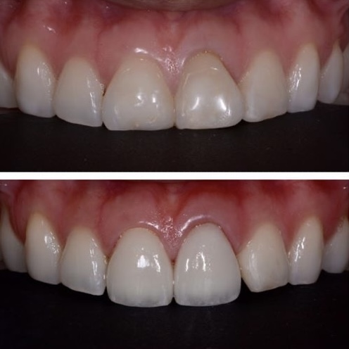 patient crown delivery dr chae (3)