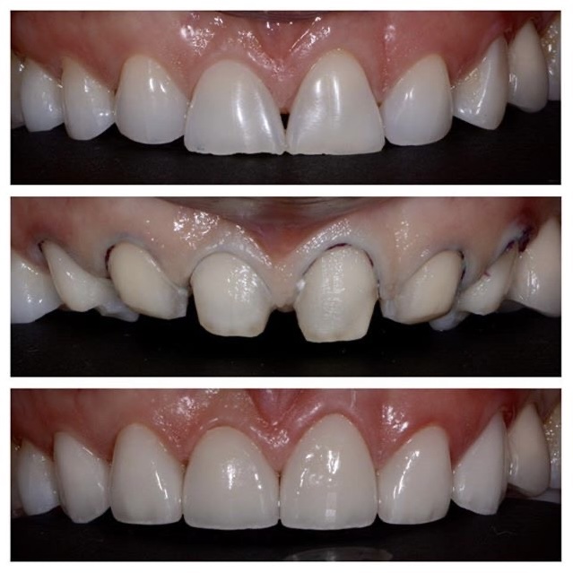 patient crown delivery dr chae (4)