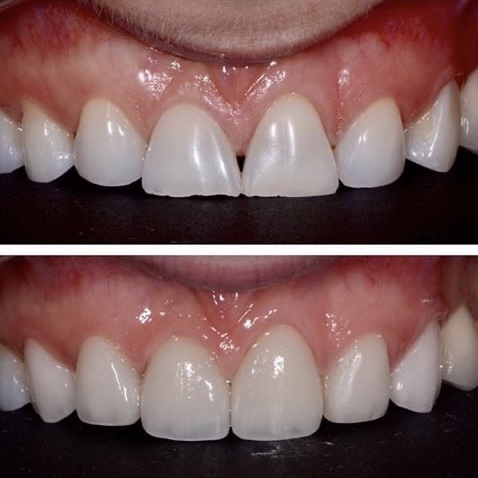 patient crown delivery dr chae (5)