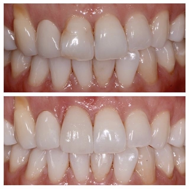 patient crown delivery dr chae (6)