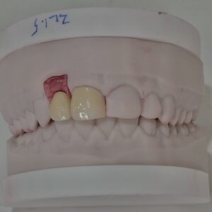 DIGITAL IMPLANT #7 CROWN #8