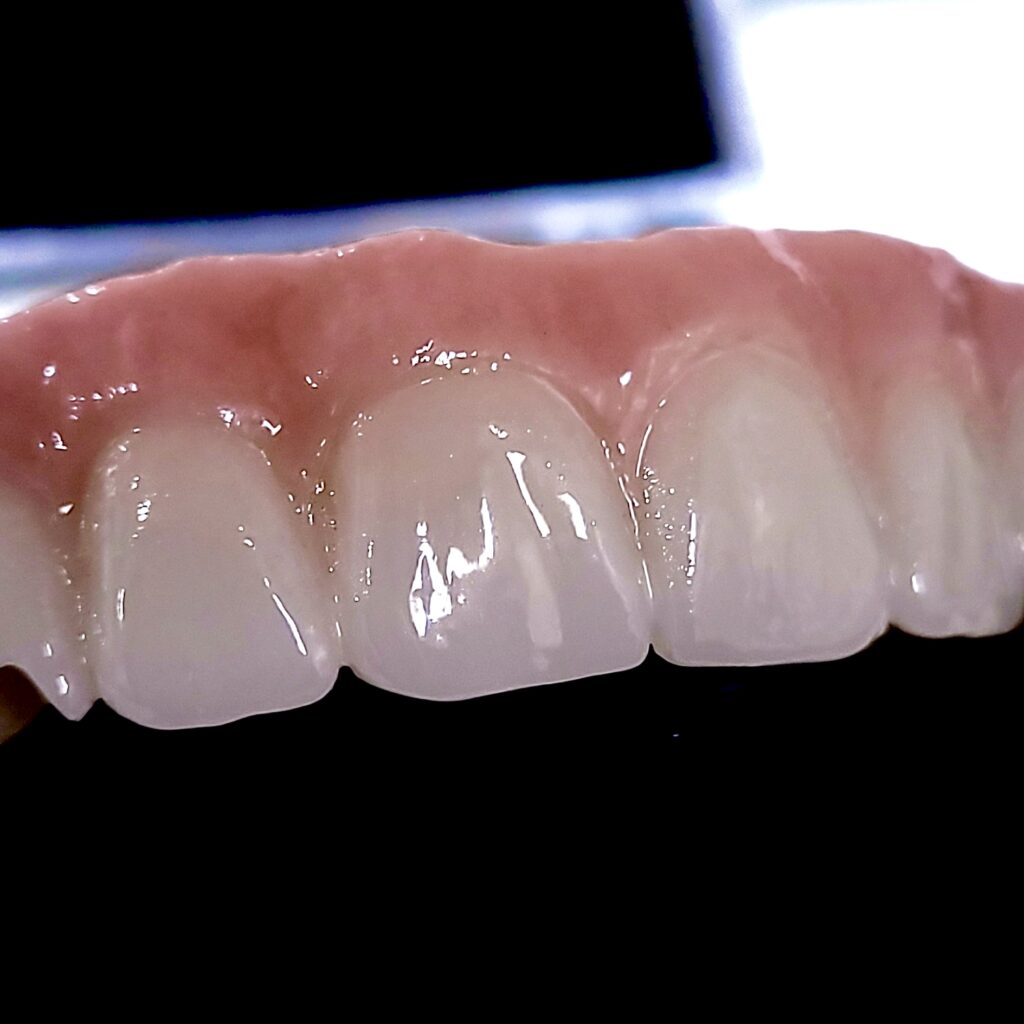 MUA Final Zirconia Bridge