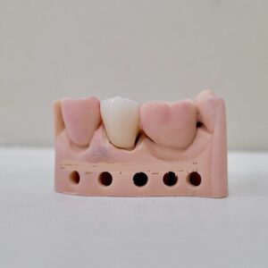 SINGLE CROWN ON DIGITAL MODEL SOLID