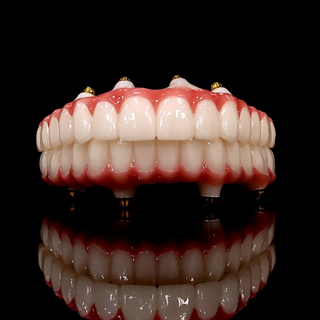 All-on-x full mouth restoration