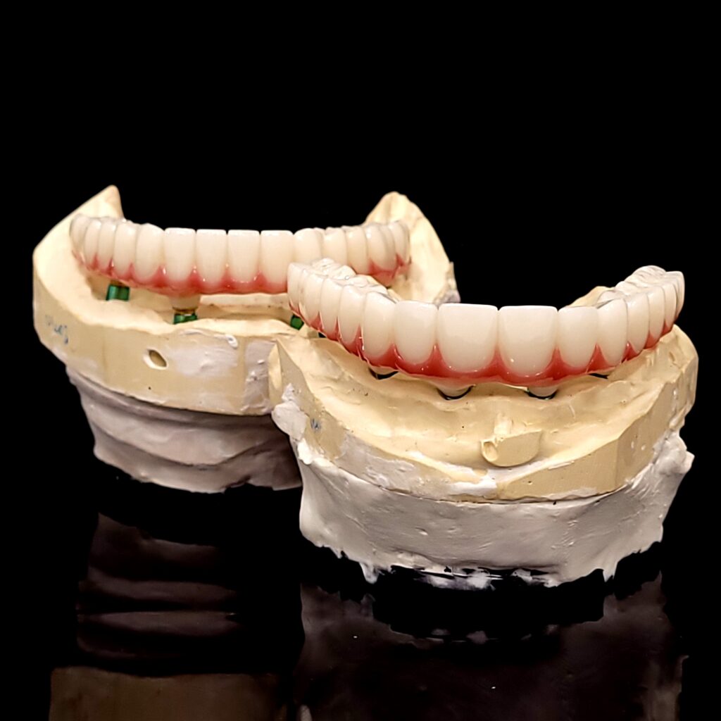 Upper and Lower arches on model