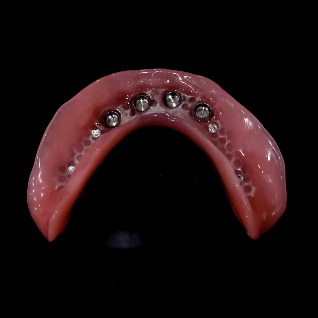 Lower Locator Overdenture Underside