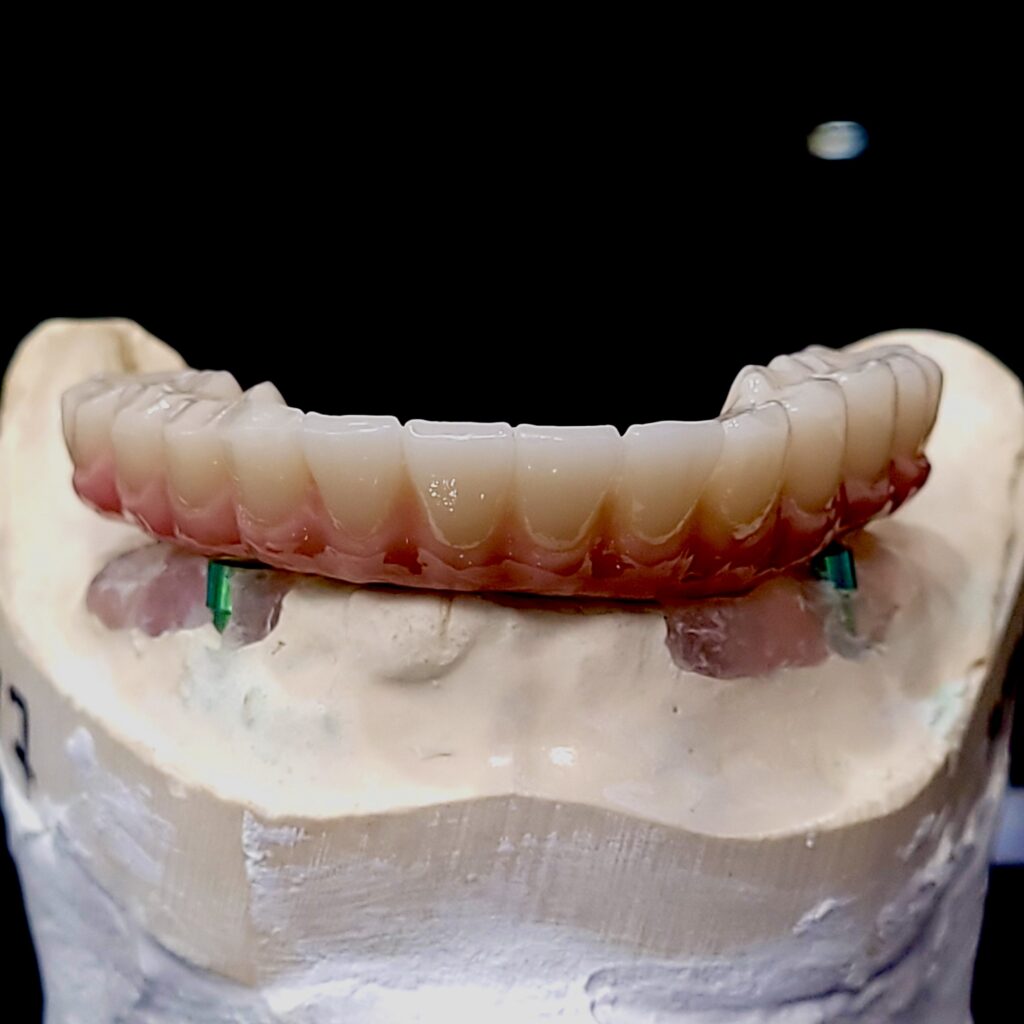 MUA Final Zirconia Bridge on Model