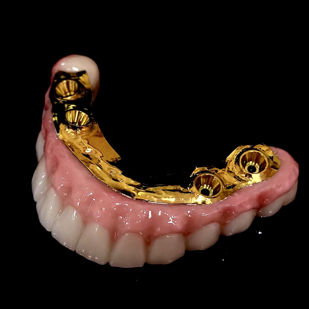MUA Final Zirconia Bridge with Titanium Bar