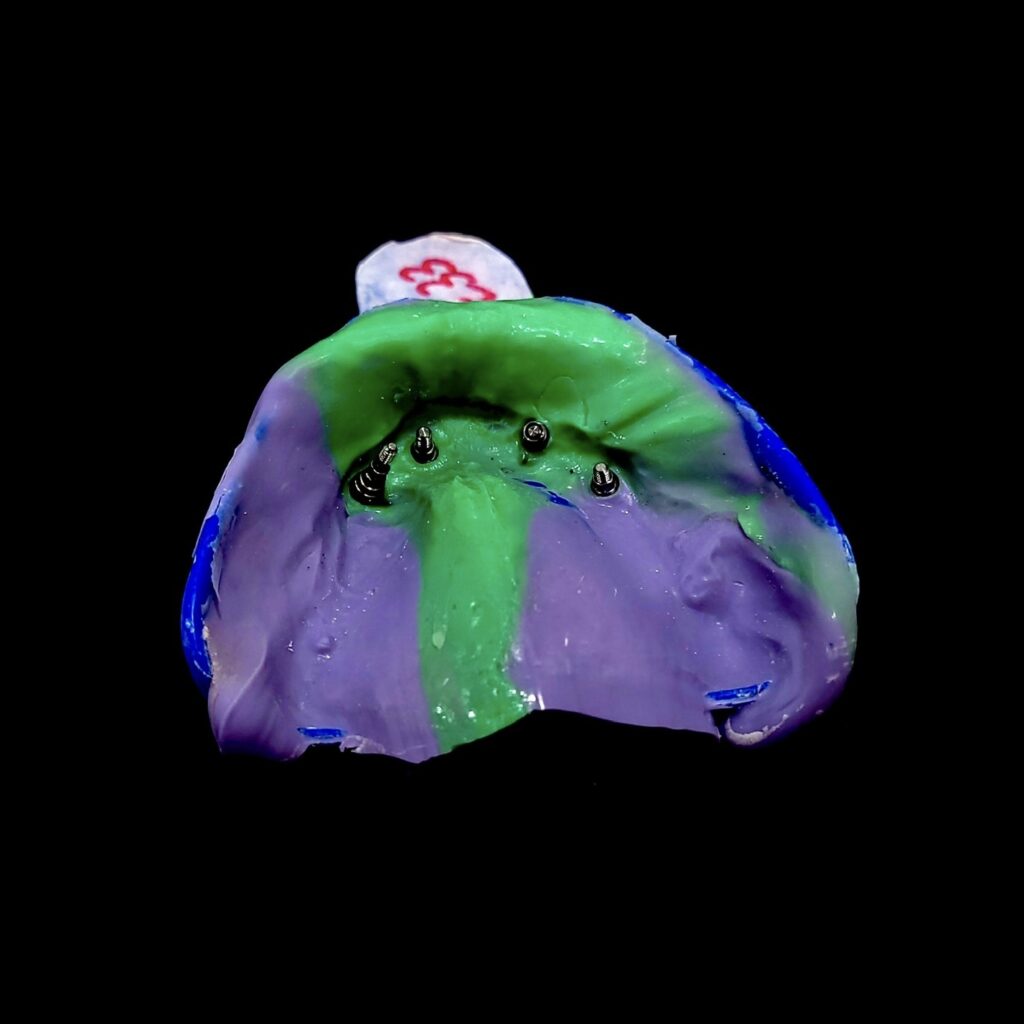 Initial implant impression with Hiossen