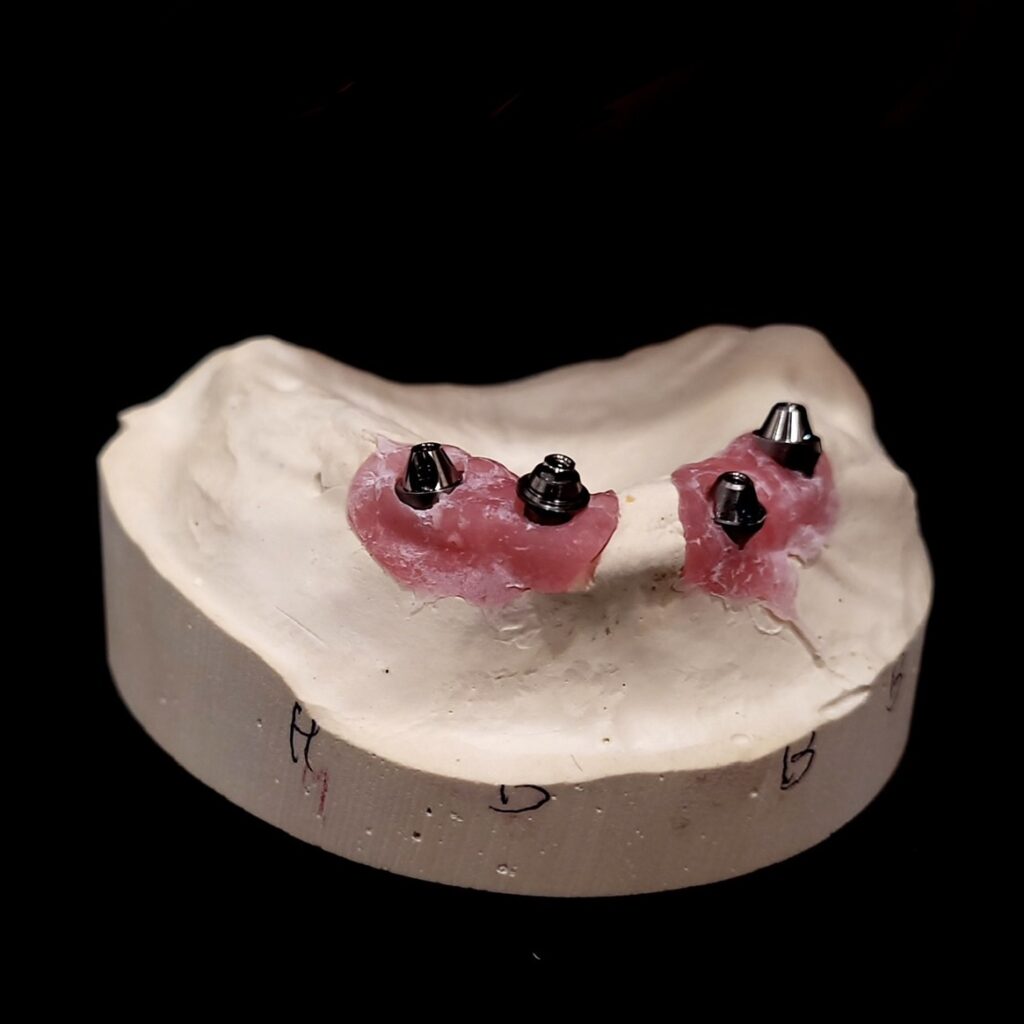 MUA abutments for dr to deliver to pt