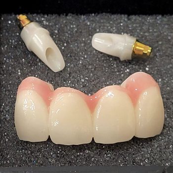 Bridge with pink porcelain, zirc abutment