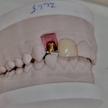 DIGITAL IMPLANT #7ABUT AND #8CROWN