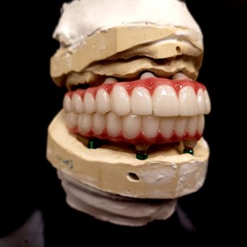 Upper and Lower arches on model