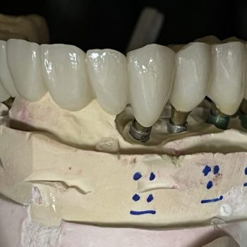 Implant Zirconia Bridges