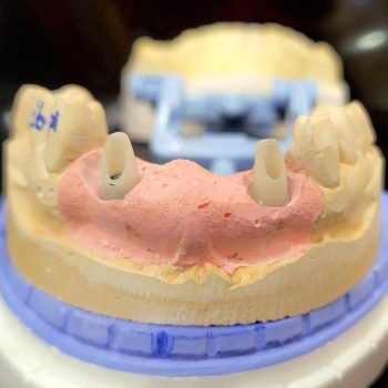 zirconia custom abutment