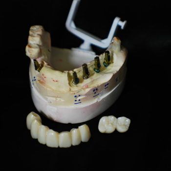cemantable implant zirconia bridges