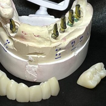 cementable implant bridges