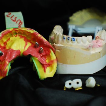 Transfer coping and screw retained zirconia crown