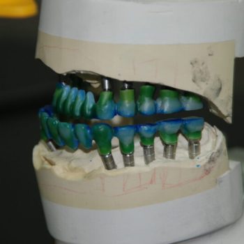 implant restoration