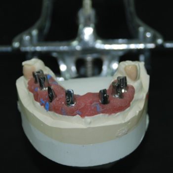 implant abutment