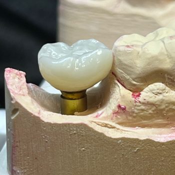 implant crown