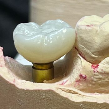 implant crown