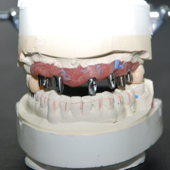 implant restoration-1