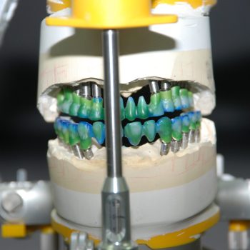 implant restoration