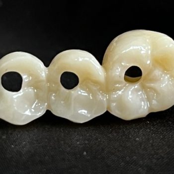 implant zirconia bridge (2)