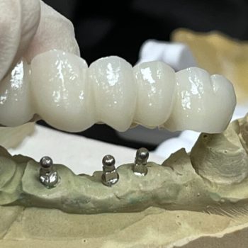 implant zirconia bridge