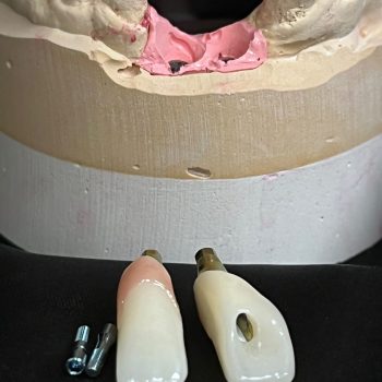 screw retained anterior crowns