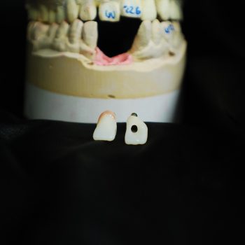screw retained zirconia crowns